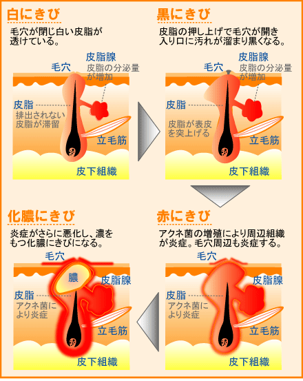 にきびの種類 にきび治療 対策大人の方へ